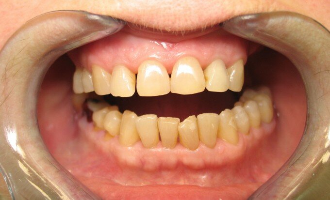 Результаты реставрации зубов ДО