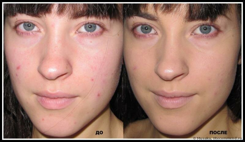Тональный крем для проблемной кожи: до и после нанесения.