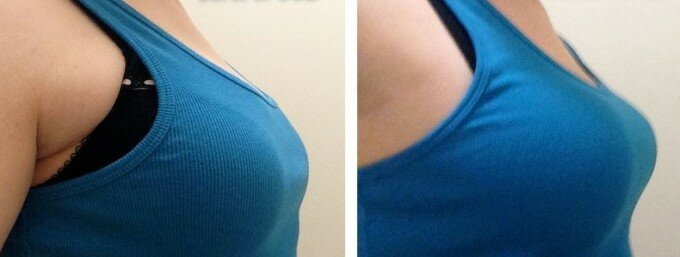 Фото до и после использования крема Slim Body для увеличения груди