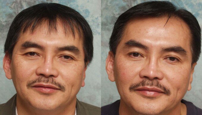 Ботокс лица фото мужчин до и после