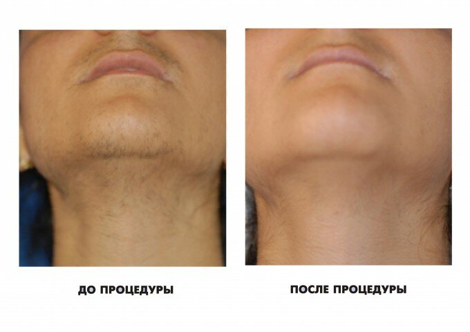 Фото до и после использования элос эпиляция у мужчин
