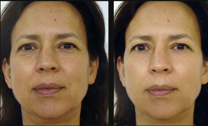 Дрожжевая домашняя маска от морщин вокруг глаз, фото до и после