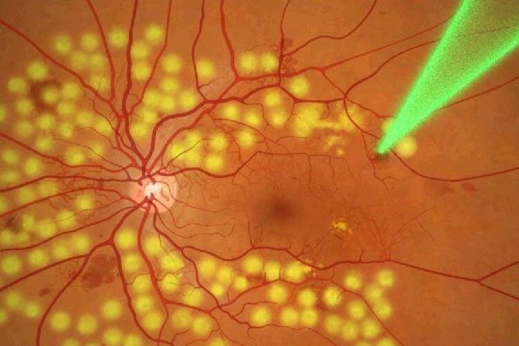 ретинопатия сетчатки при диабете - симптомы, лечение